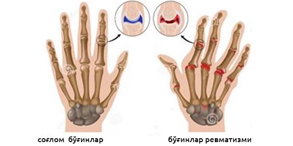 Ревматизм (бод) хуружида